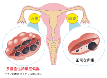 多嚢胞性卵巣症候群PCOS