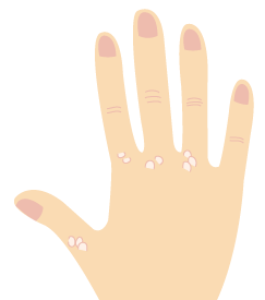 いぼ★漢方の厚生堂におまかせください