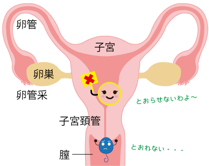 子宮頸管の精子通過障害